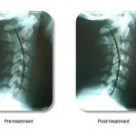 Canadian chiropractors, colleges battle over X-rays