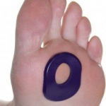 Callus formation and orthotic support