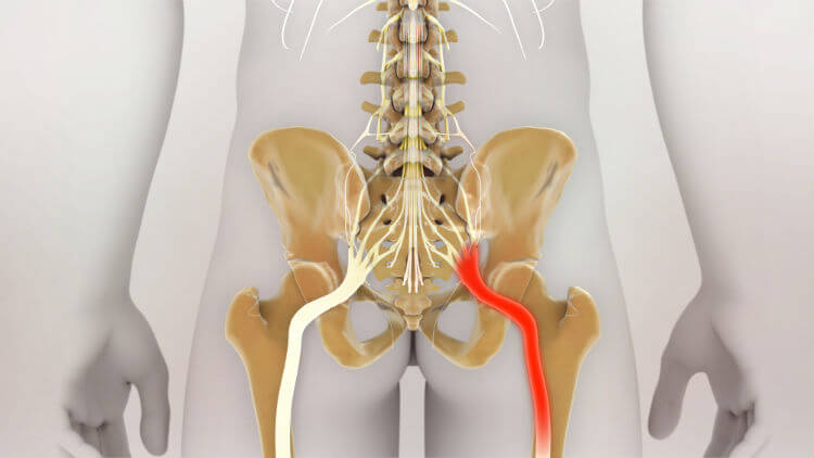 For patients dealing with issues from sciatica and high heels, keeping the heel height under two inches can help