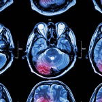 10 ways for DCs to survive a stroke malpractice claim