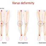 Foot Levelers stabilizers decrease Q-angle: A study of flexible orthotics