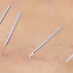 Superficial vs. deep dry needling: What science tells us